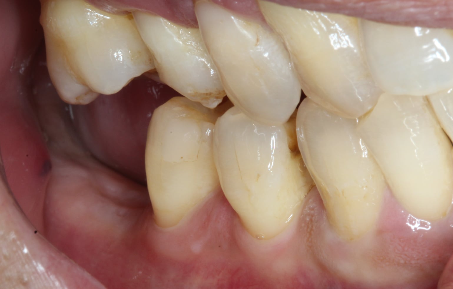 Edentulous Area