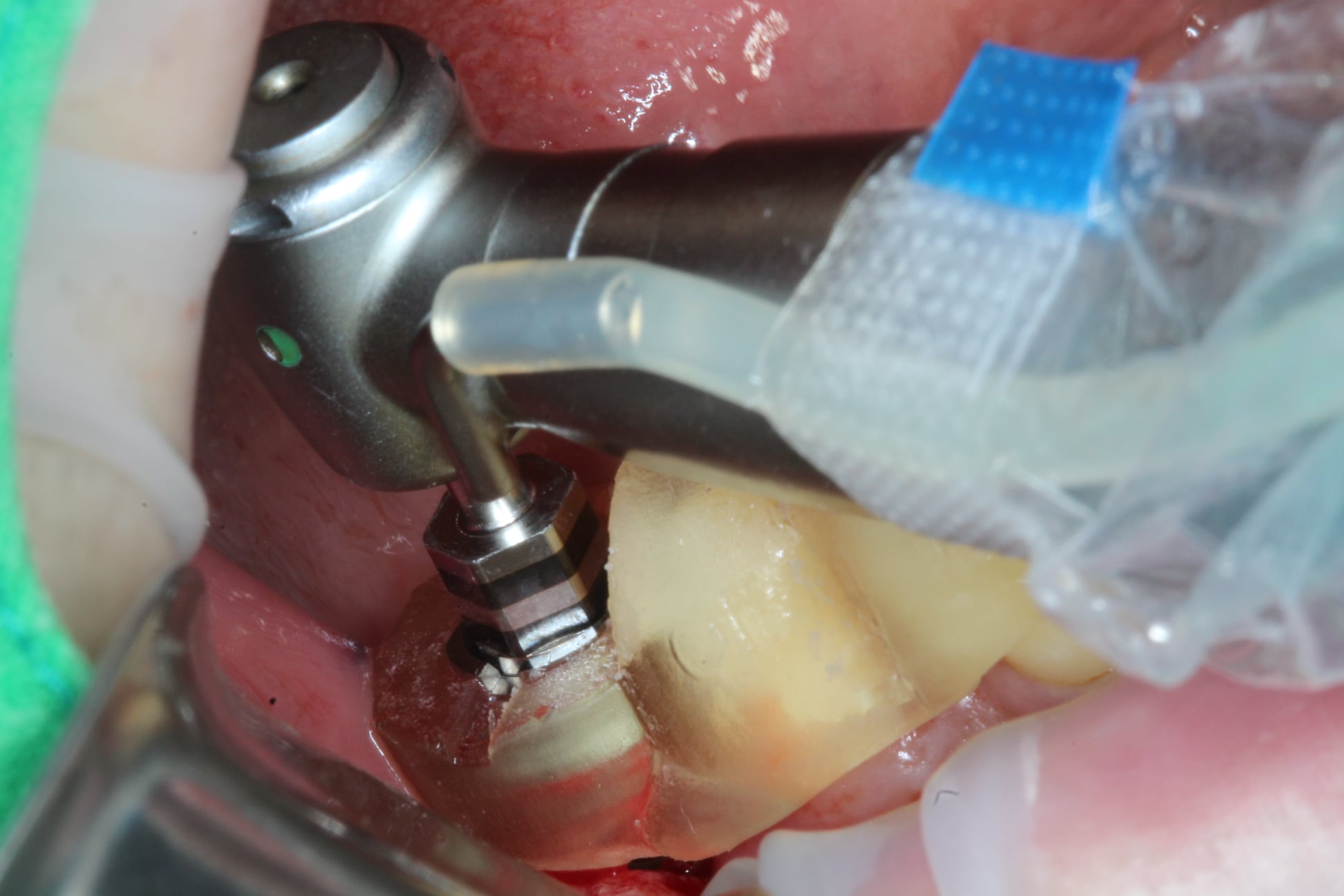 Edentulous Area