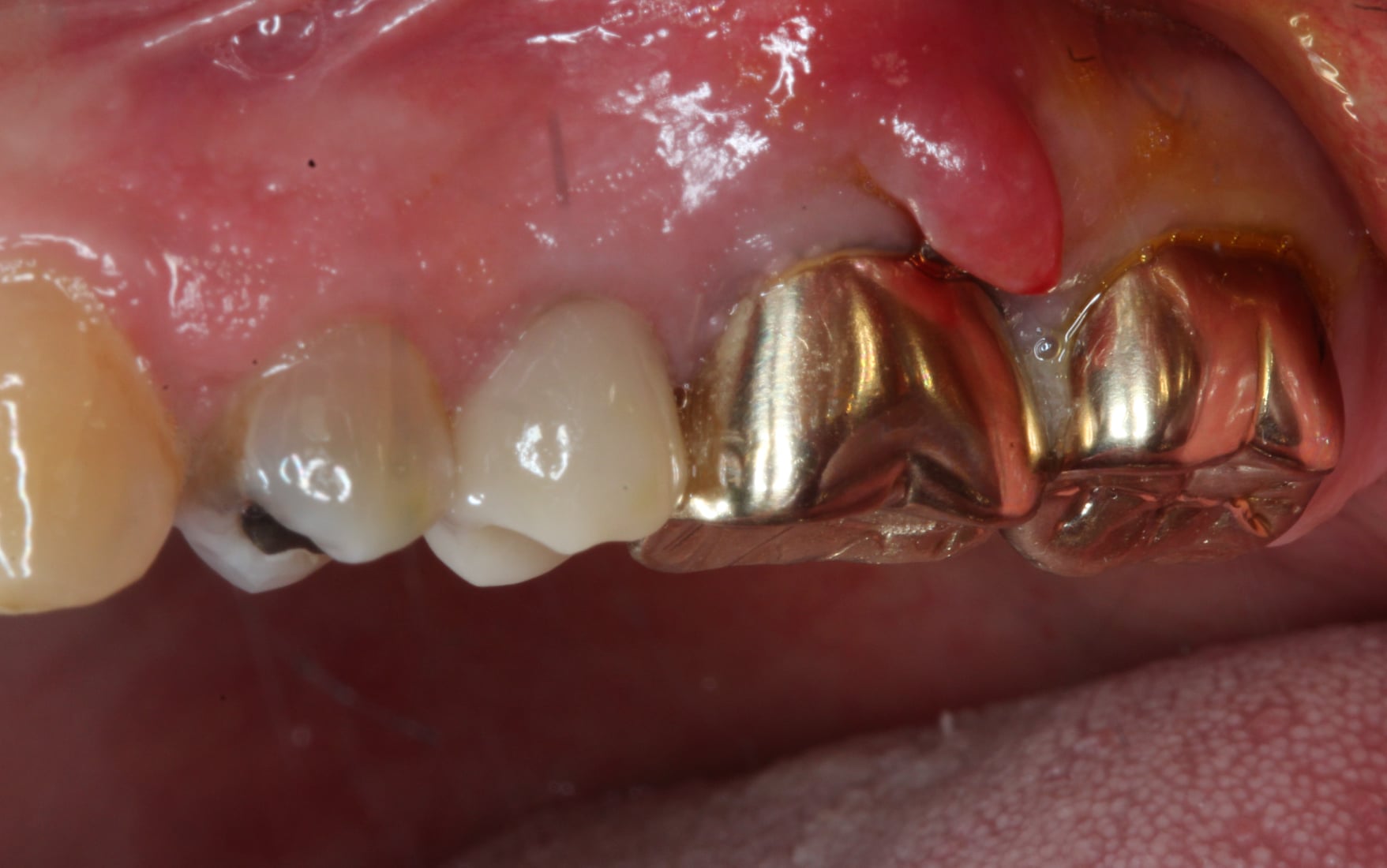 Mesiobuccal Fracture