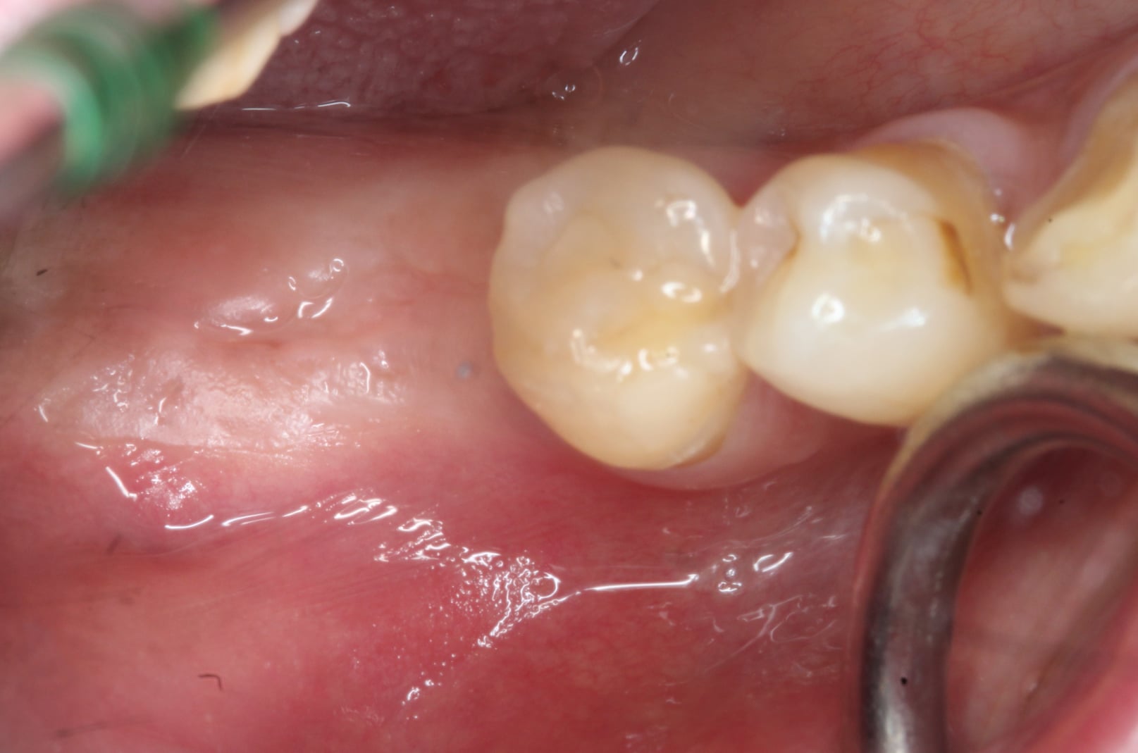 Edentulous Area