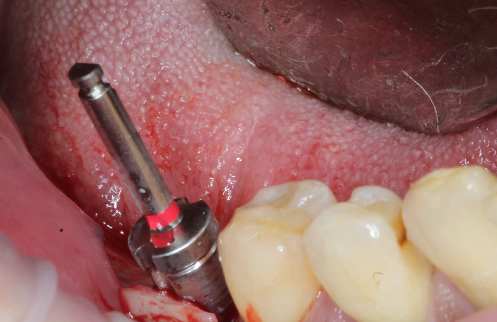 Edentulous Area