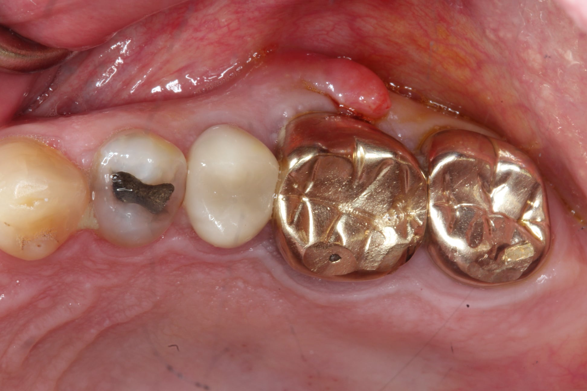 Mesiobuccal Fracture