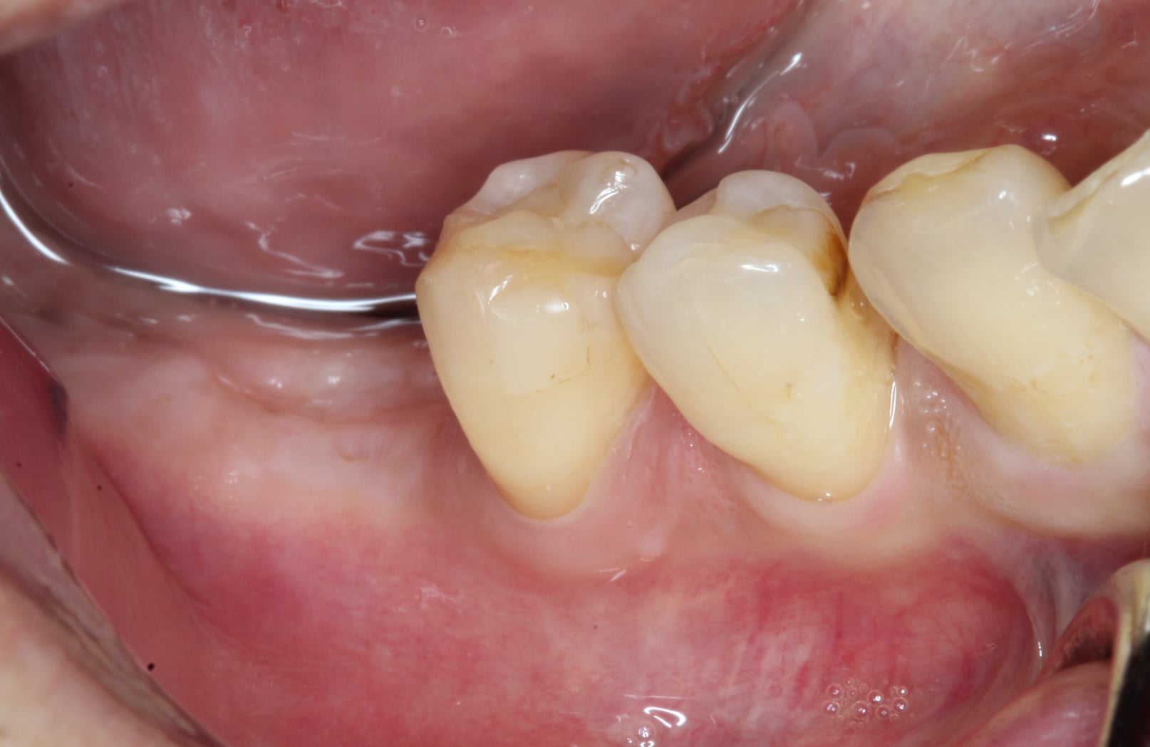 Edentulous Area