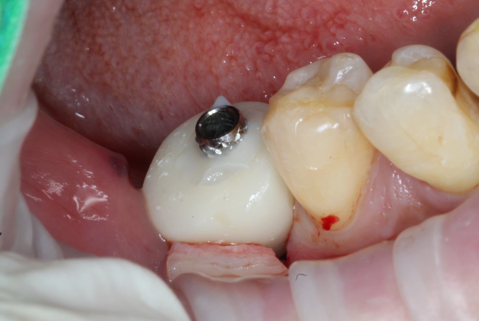 Edentulous Area