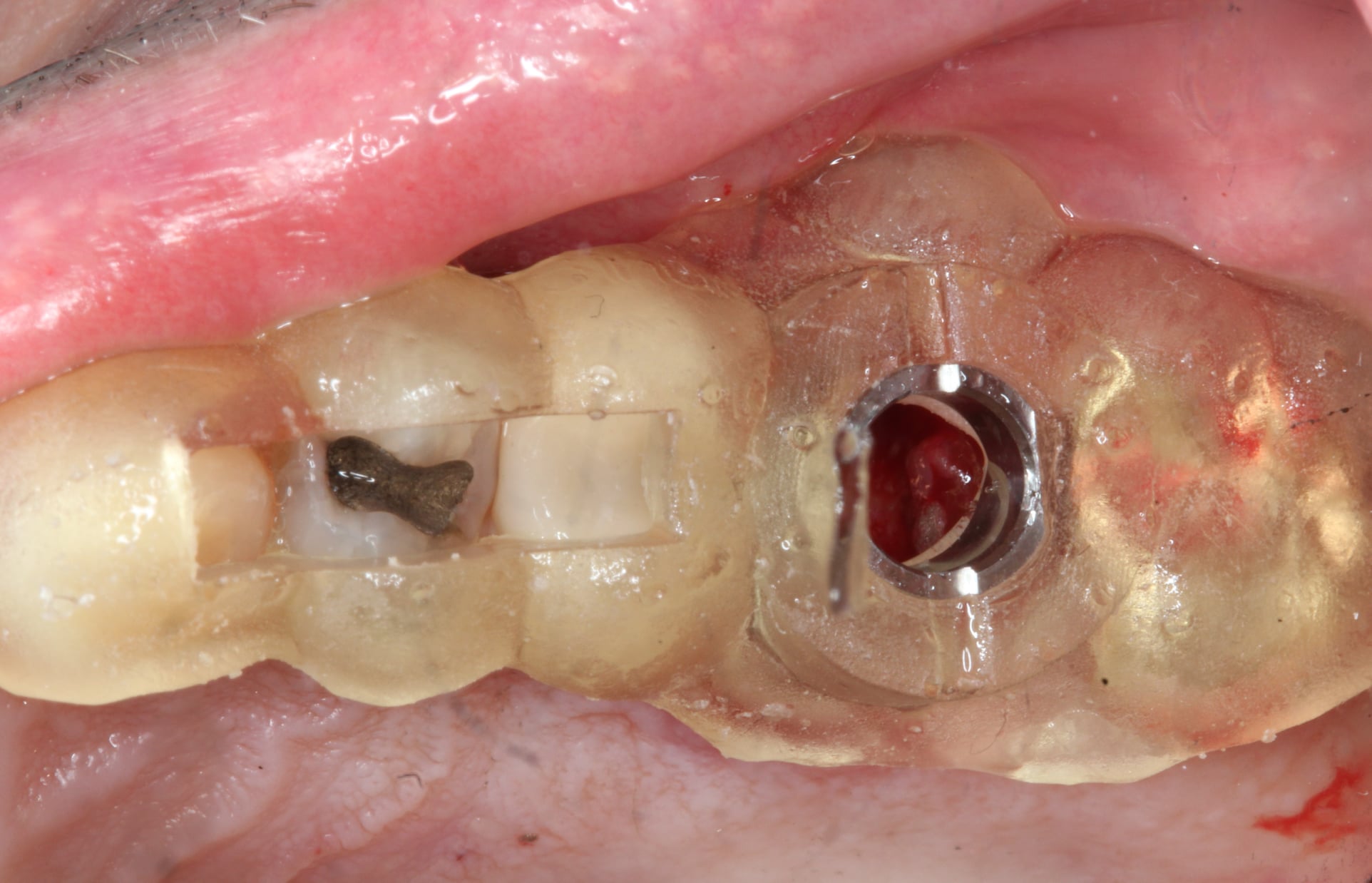 Mesiobuccal Fracture