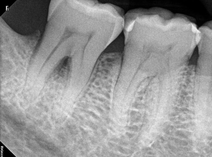 furcation involvment