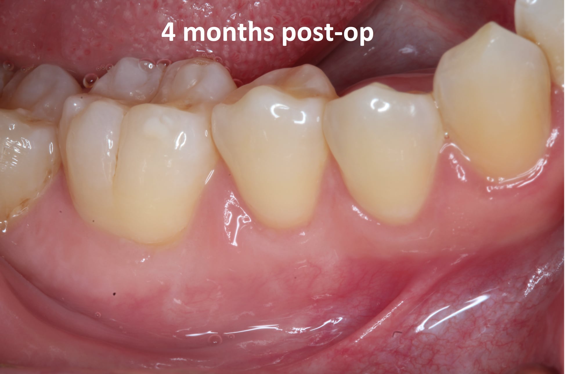 connective tissue graft