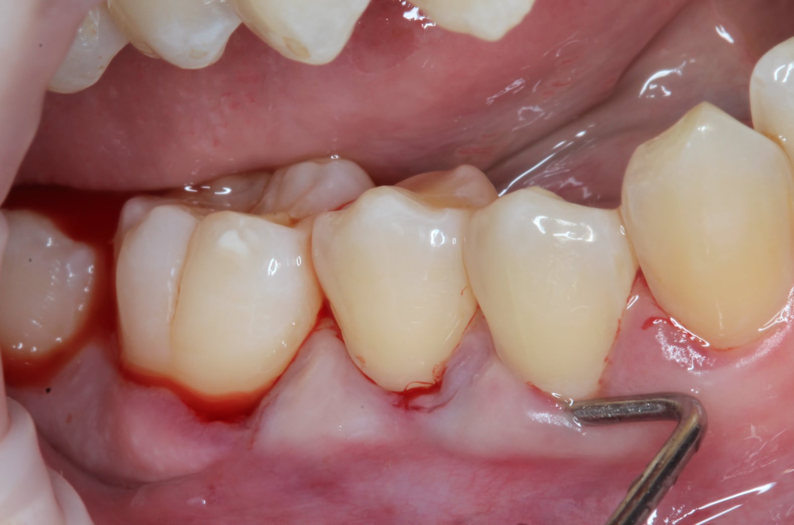 connective tissue graft