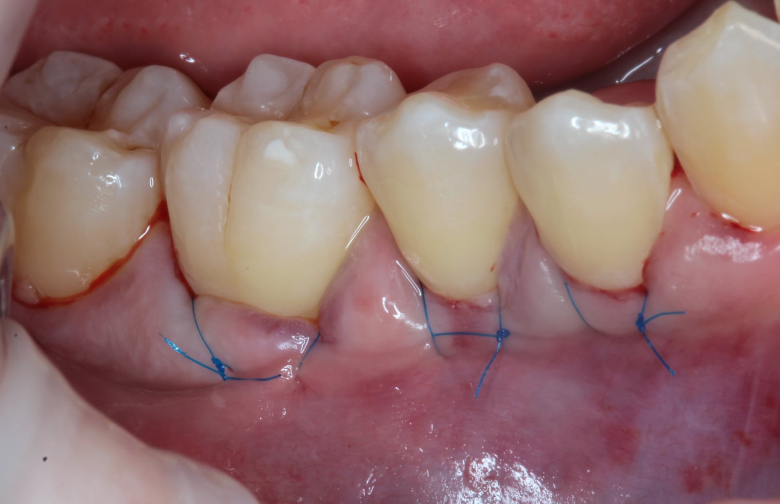 connective tissue graft