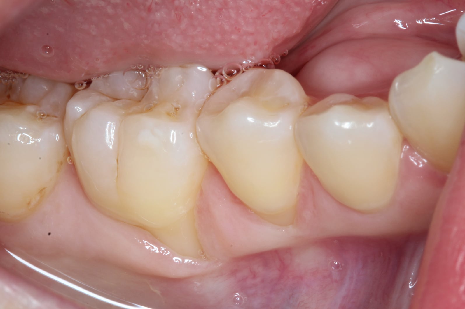 connective tissue graft