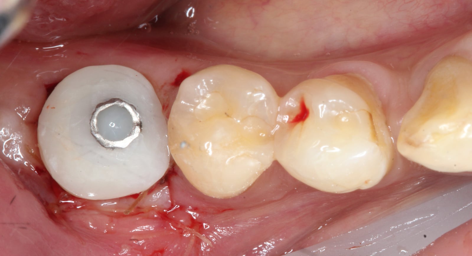 Edentulous Area