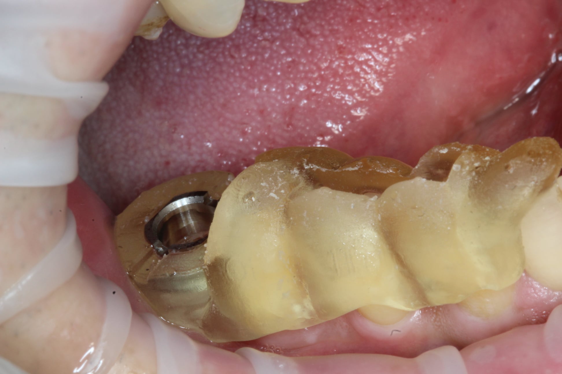 Edentulous Area