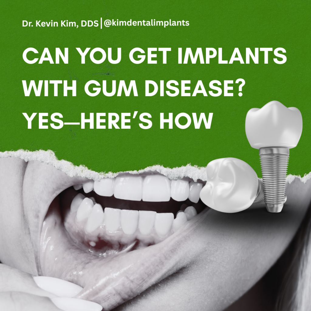 Can You Get Implants with Gum Disease?