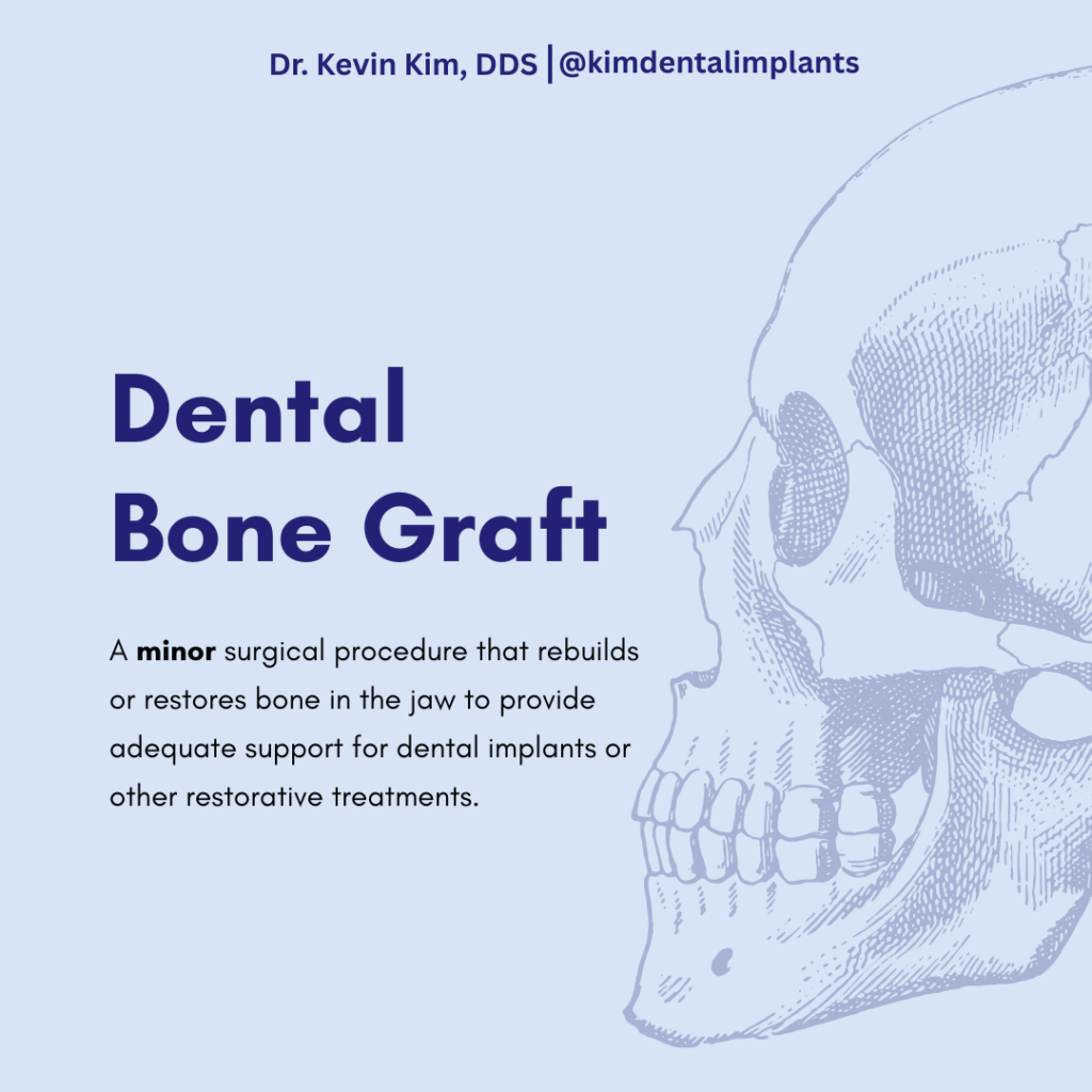 Dental bone graft illustration with Dr. Kevin Kim DDS text and skull graphic explaining minor surgical procedure