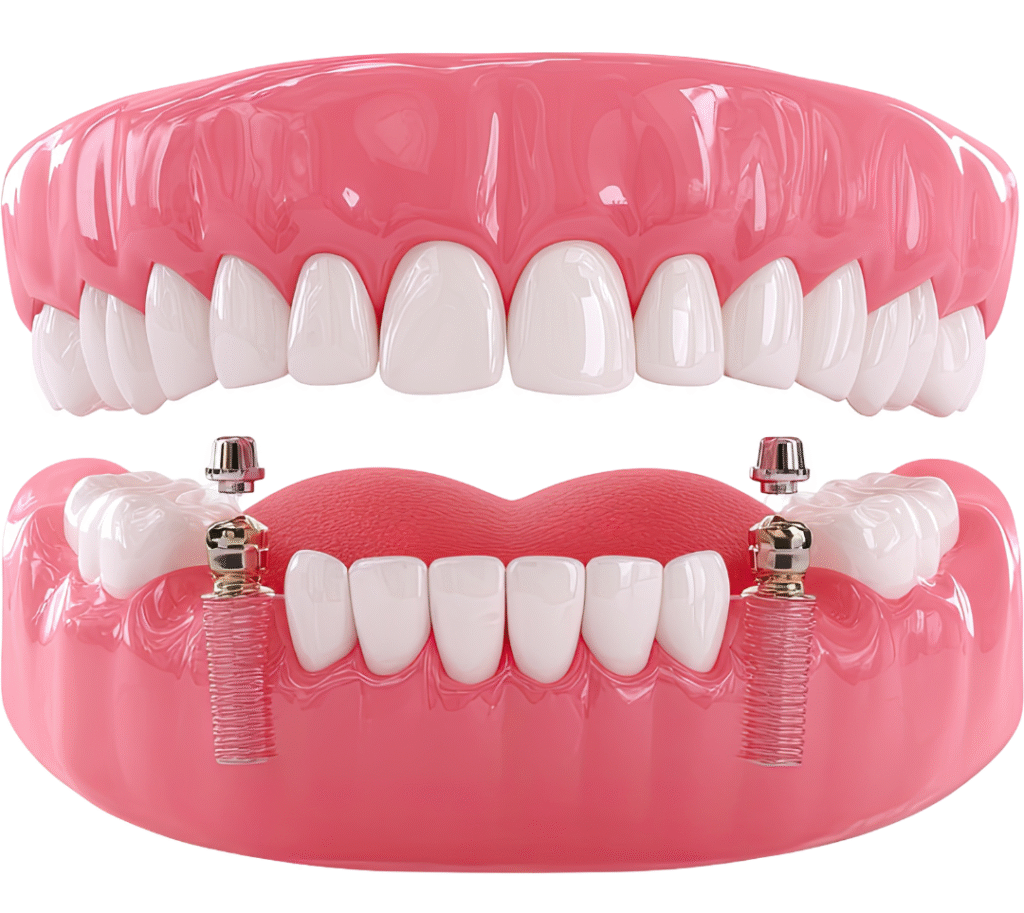 An anatomical model of the upper and lower jaw with a focus on two specialized titanium implants positioned in the posterior molar region, extending into the pterygoid bone area.