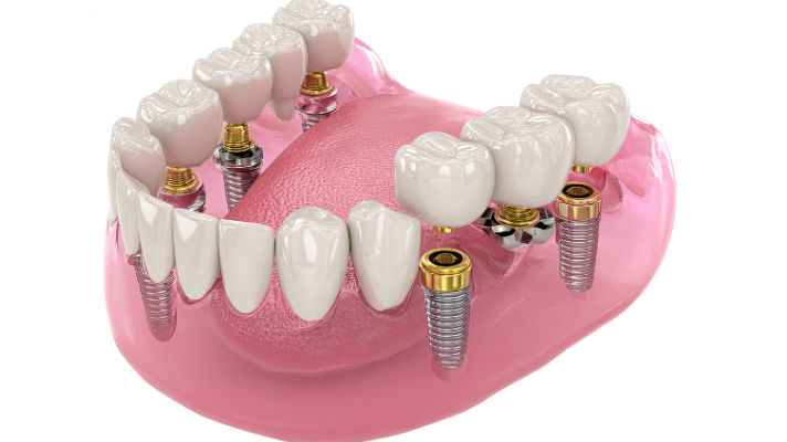 A 3D anatomical model of a lower jaw showing six titanium implant posts with gold-colored abutments supporting a full-arch porcelain bridge.