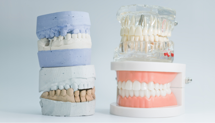 A side-by-side comparison of traditional blue and white plaster dental molds next to a modern clear anatomical model showing a full arch of dental implants.