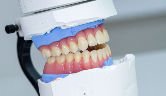 A custom-crafted set of hybrid dentures held in a blue and white dental articulator used to simulate a patient's natural bite and jaw movement.