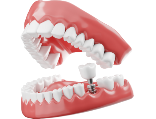 A 3D anatomical illustration showing the three parts of a single tooth implant: the titanium post, the connecting abutment, and the custom porcelain crown.