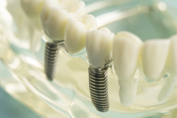 A clear dental model showing three titanium screw-style implants securely anchored into the jawline, supporting life-like porcelain crowns.