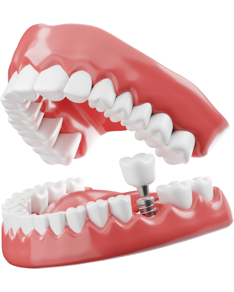 A 3D medical illustration of a human jaw model with a dental implant and porcelain crown being precisely fitted into the lower ridge.