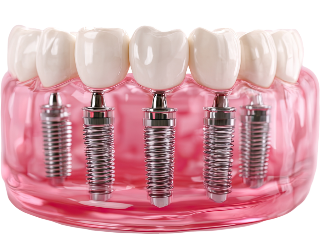 A high-resolution 3D anatomical model of a lower jaw featuring five titanium dental implants supporting a full-arch bridge restoration, emphasizing the stability of professional replacement.