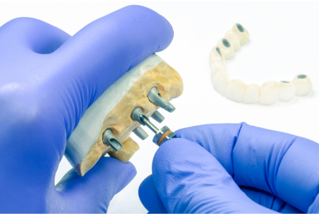 A dental professional wearing purple surgical gloves uses a specialized tool to carefully remove a failed titanium implant from a stone jaw model, with a multi-unit bridge restoration in the background.