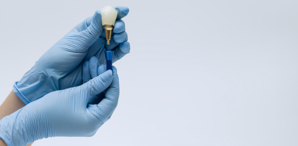 A dental professional wearing blue surgical gloves carefully assembling a two-piece dental implant system consisting of a titanium post, an abutment, and a porcelain crown.