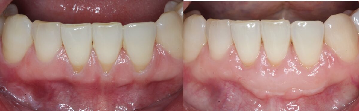 Before and After Dental Implants photos