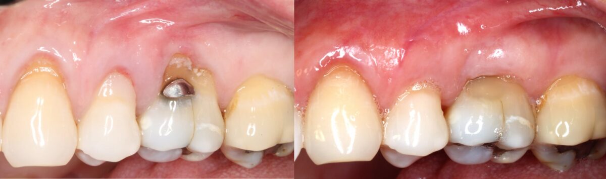 Before and After dental implant smile gallery