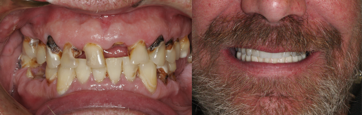 Before and after dental implants photos