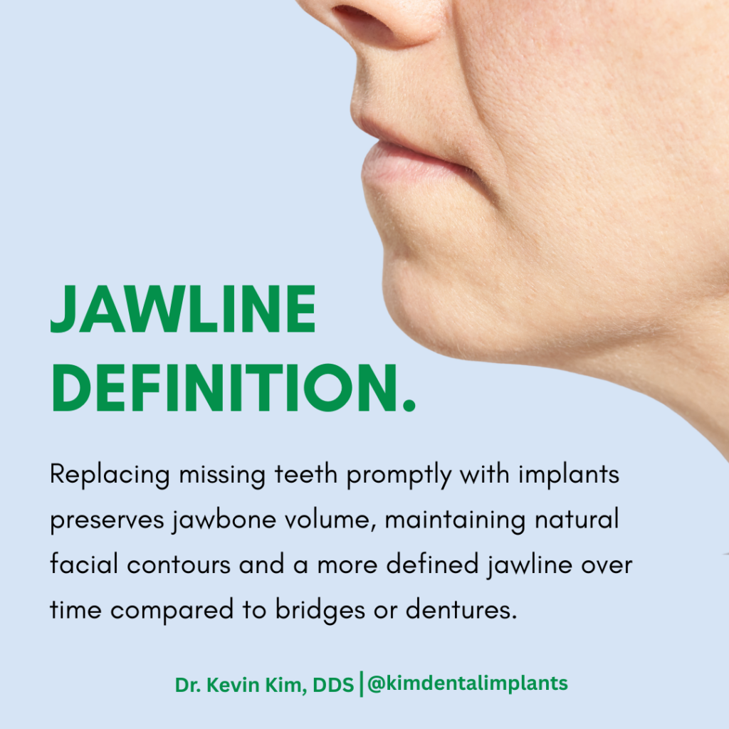 A medical diagram demonstrating how dental implants preserve your facial structure by preventing jawbone loss after tooth removal.