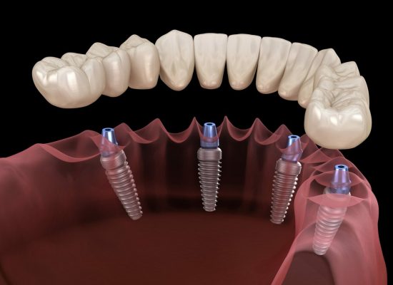 All-on-4 Full Arch Implant