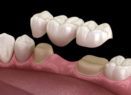dental bridge