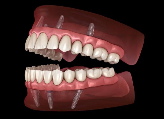 Full Mouth Restoration