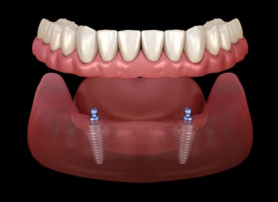 Removable Overdentures