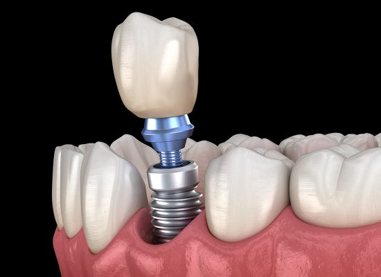 single tooth implant